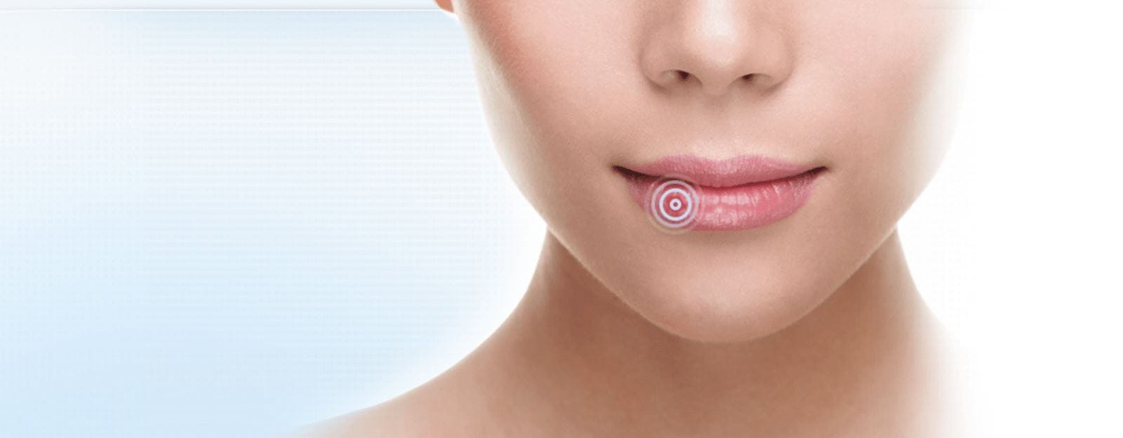 cómo curar un herpes labial