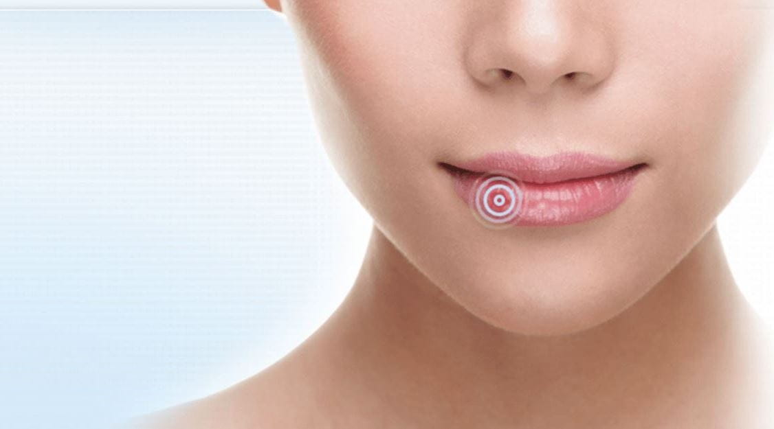 cómo curar un herpes labial