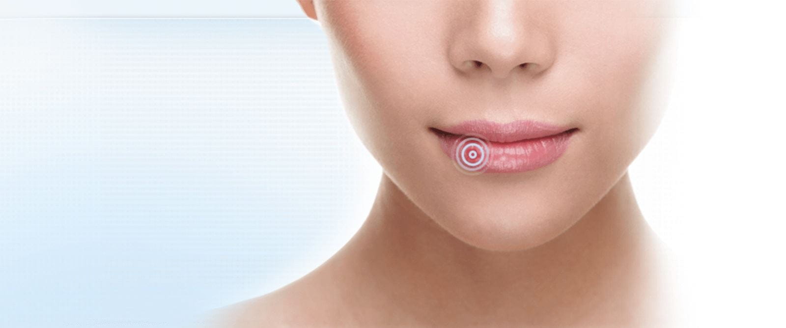 mulher com herpes labial