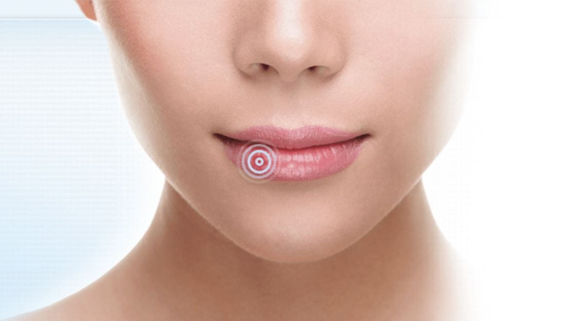mulher com herpes labial