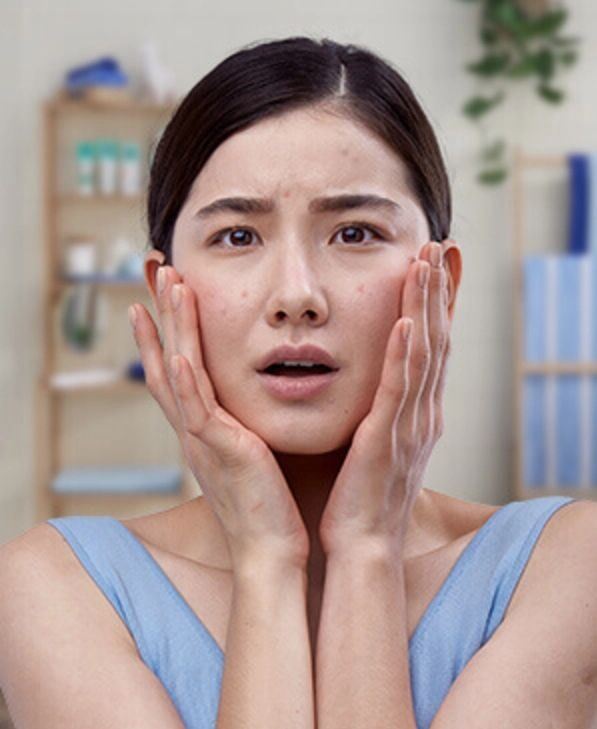 mulher com marcas de acne