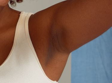 woman applying nivea rebalance and clear serum for blemish free skin