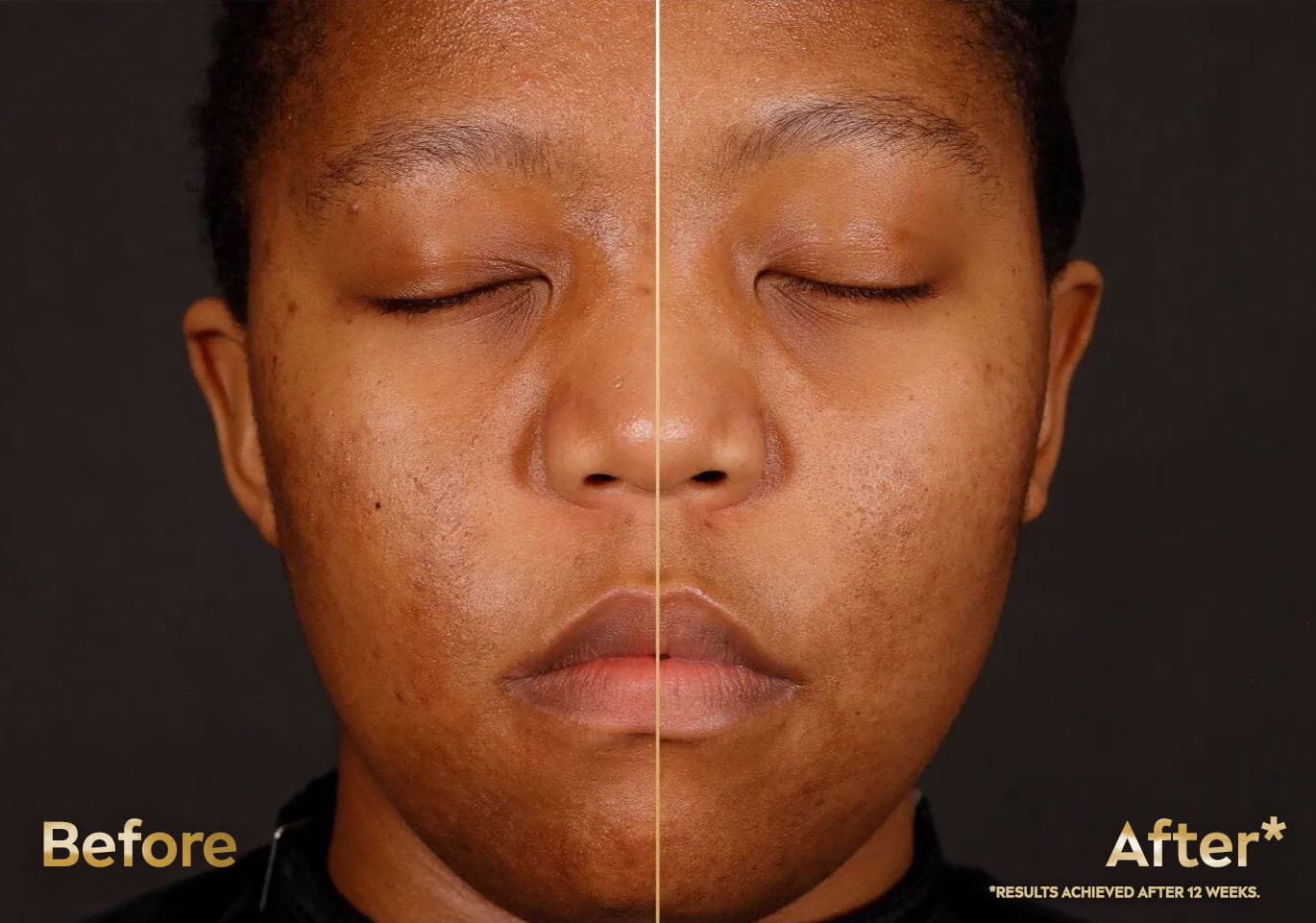 Before and after Nivea Luminous 630 on a young dark-skinned woman, showing reduced dark spots, sun spots, age spots, and post-acne marks after 4 weeks.