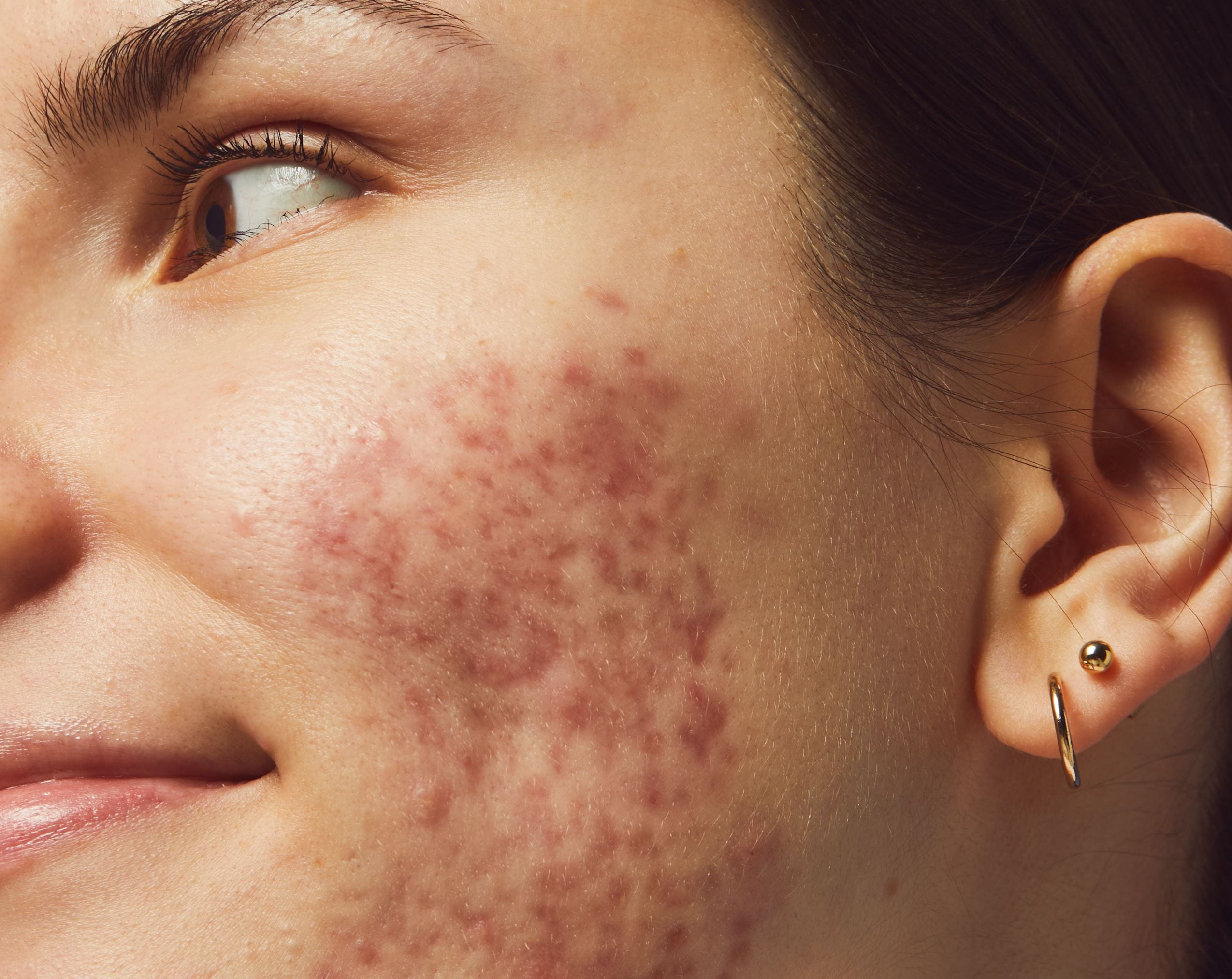 close up of woman with breakouts on cheek