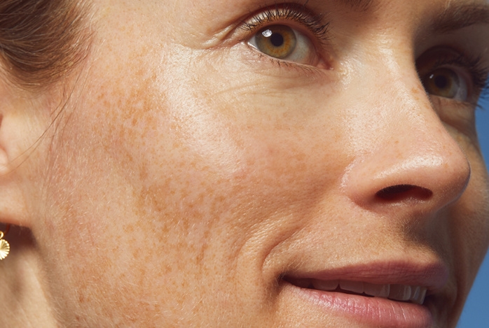 lady with freckles and sunscreen