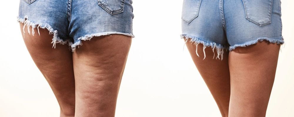 BLOG TRATAMENTO PARA CELULITE: QUAL O MELHOR E COMO ESCOLHER? 1