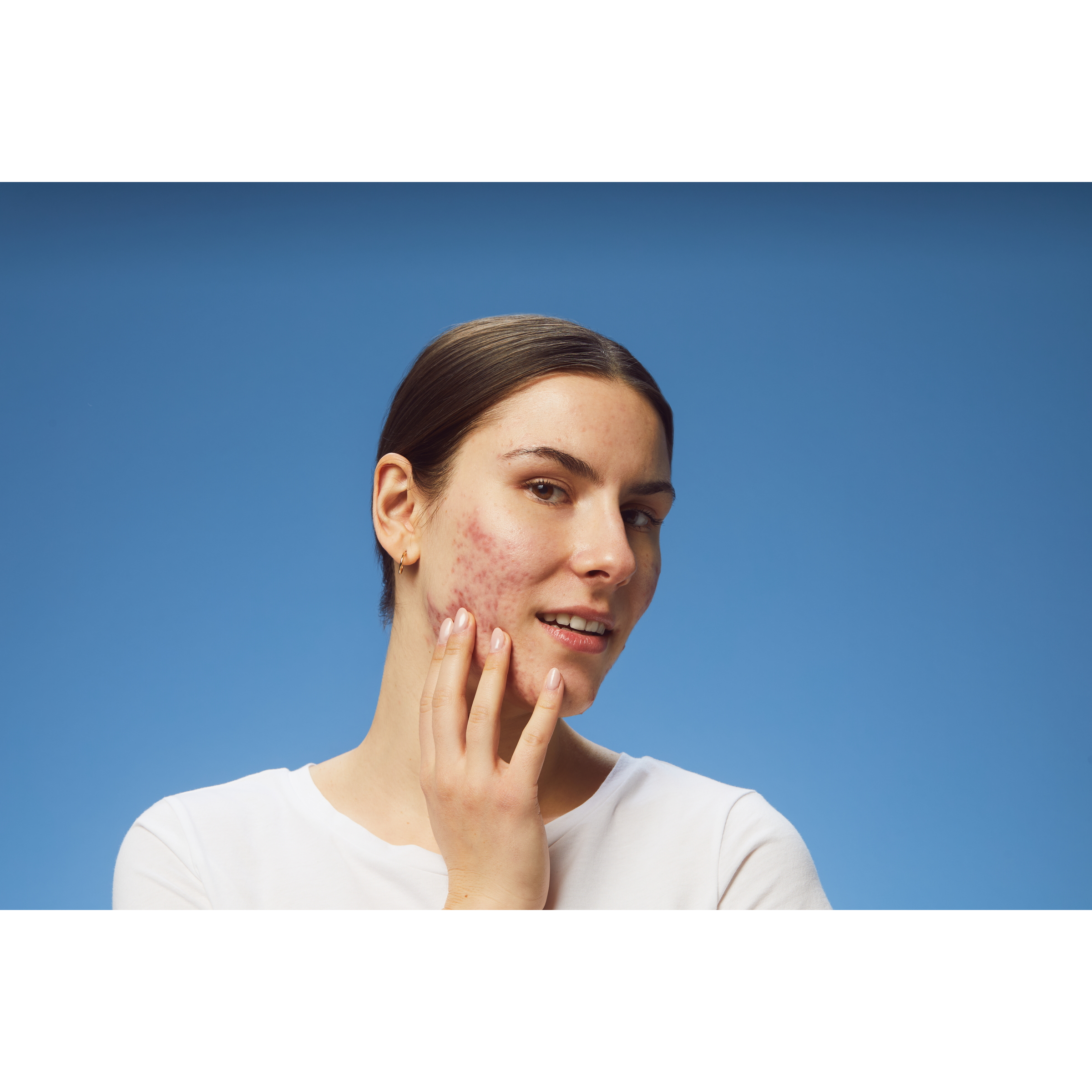 femme avec acne sur les joues