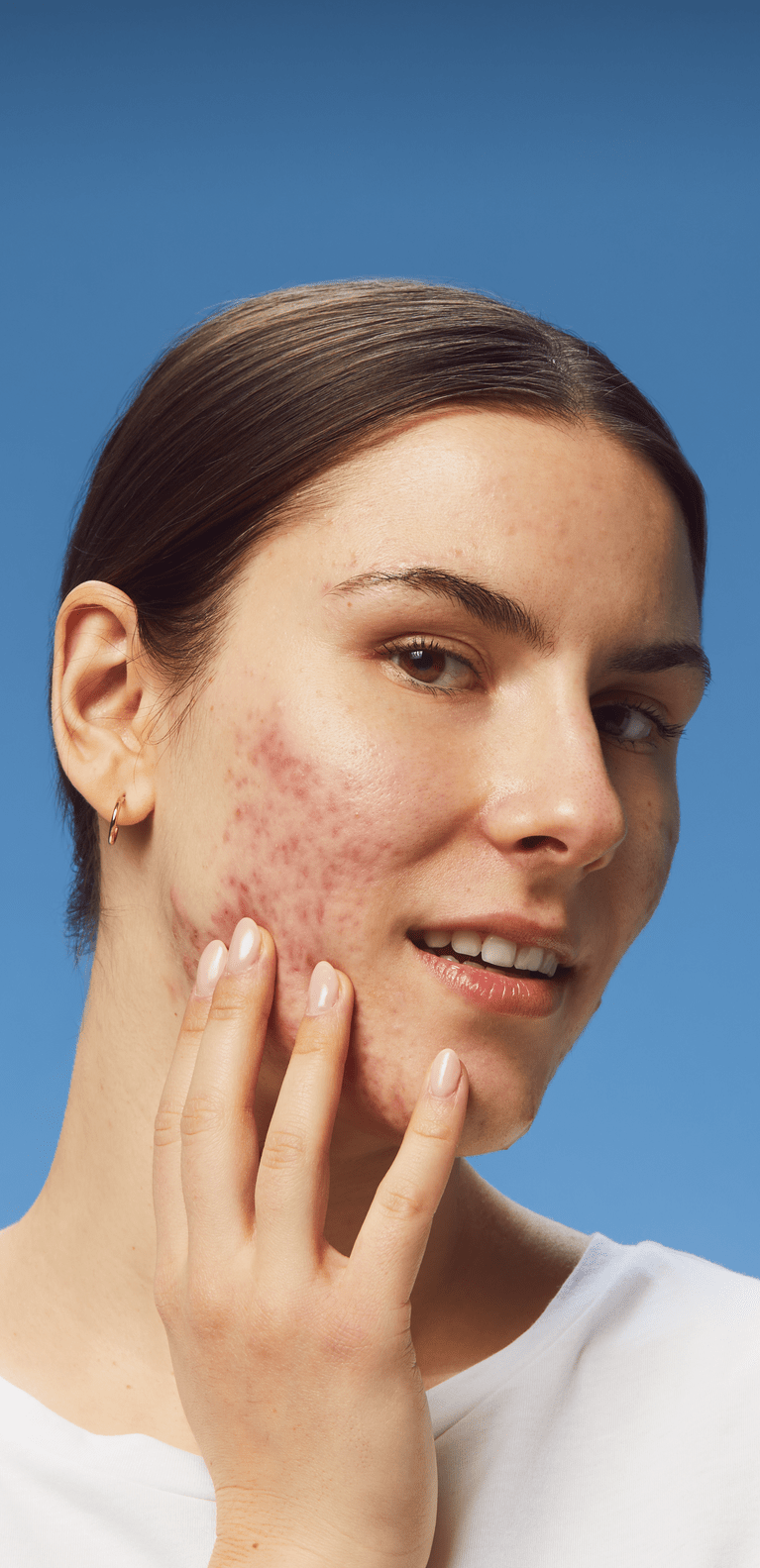femme avec acne sur les joues