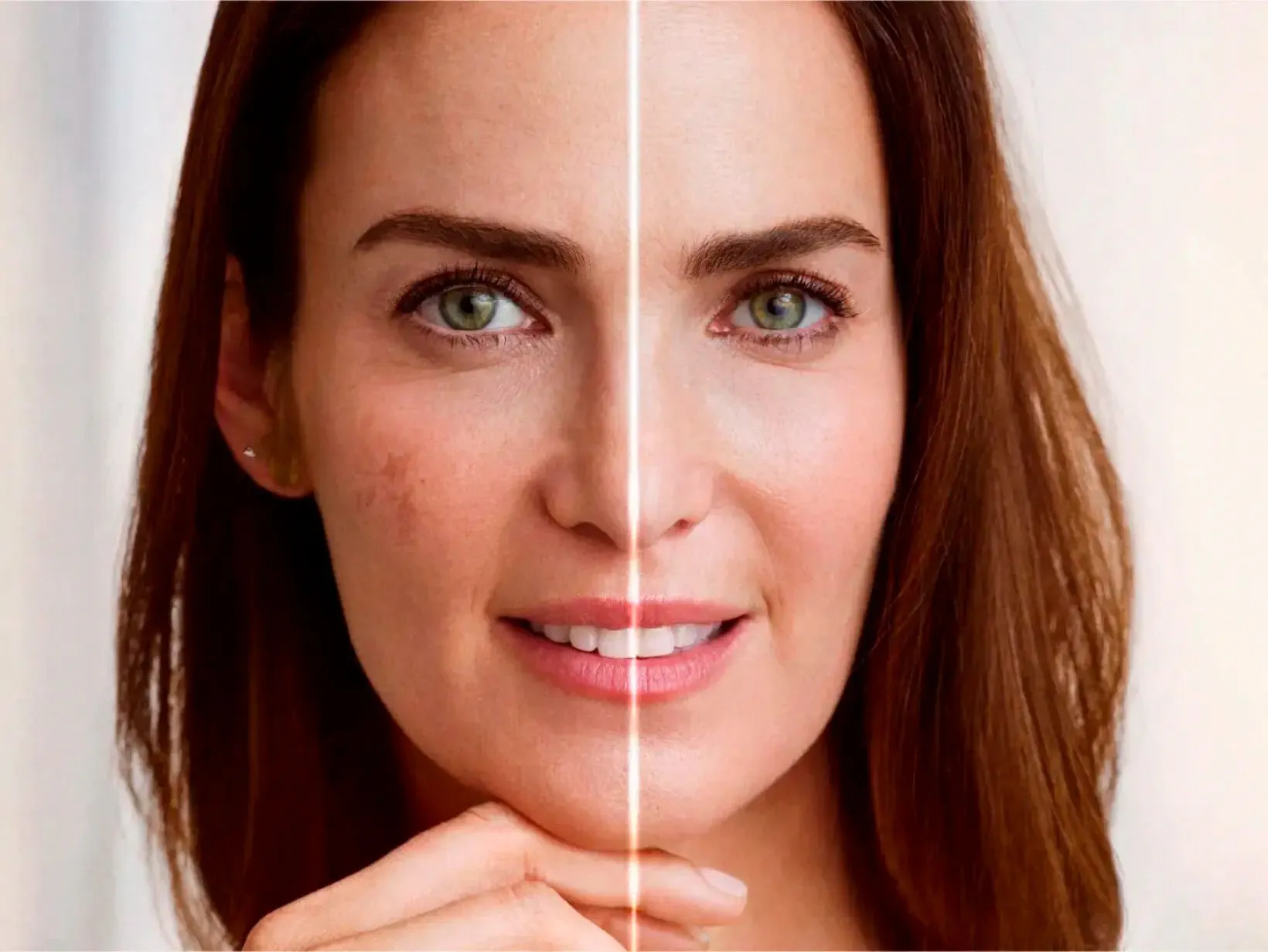 LP Luminous 630 Antiacne 1