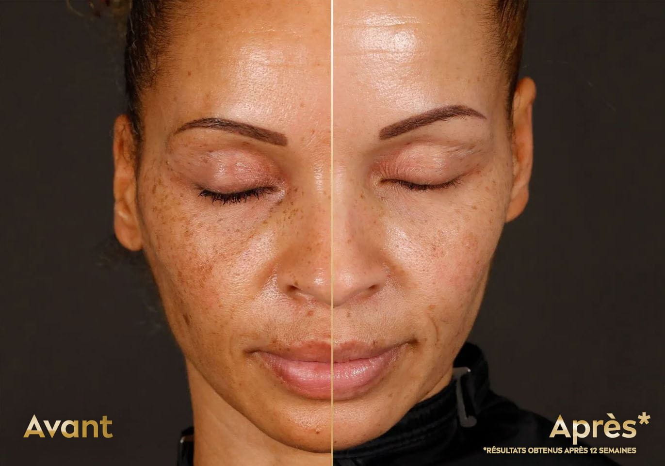 Effets avant et après 4 semaines d'utilisation de la gamme Luminous630® de Nivea sur le visage d'une femme d'âge moyen à la peau brune, montrant une réduction des taches brunes, des taches d'exposition au soleil, des taches de vieillissement et des marques post-acnéiques.