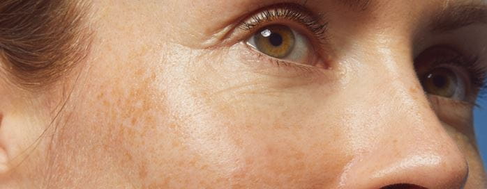 Femme vérifiant sa peau