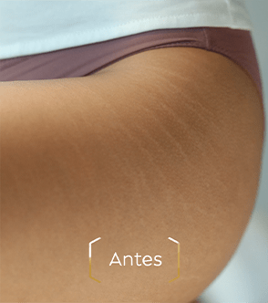 Estrías antes de Nivea Luminous Anti estrías