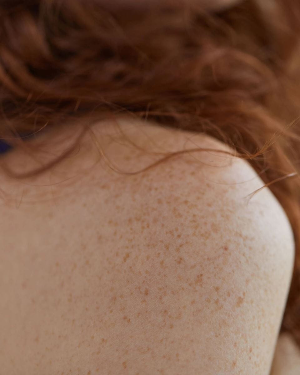 femme avec des taches de rousseur sur le dos