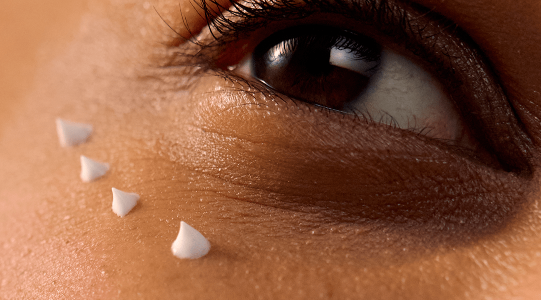 Hogyan szabaduljunk meg a szem alatti karikáktól