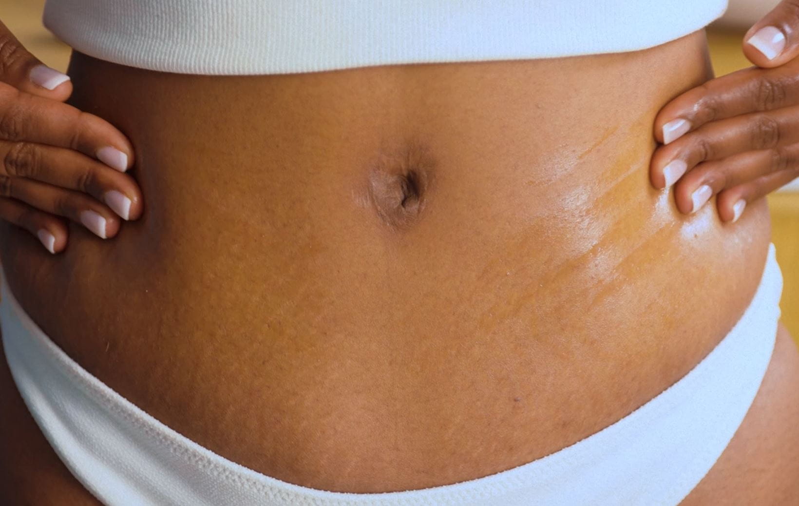 estrias no estômago