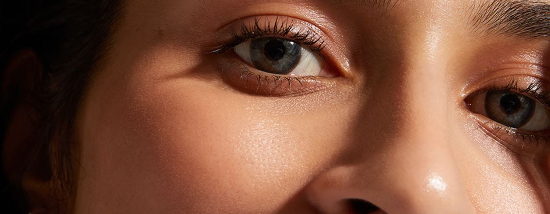 Why do dark circles under the eyes occur and how to treat them