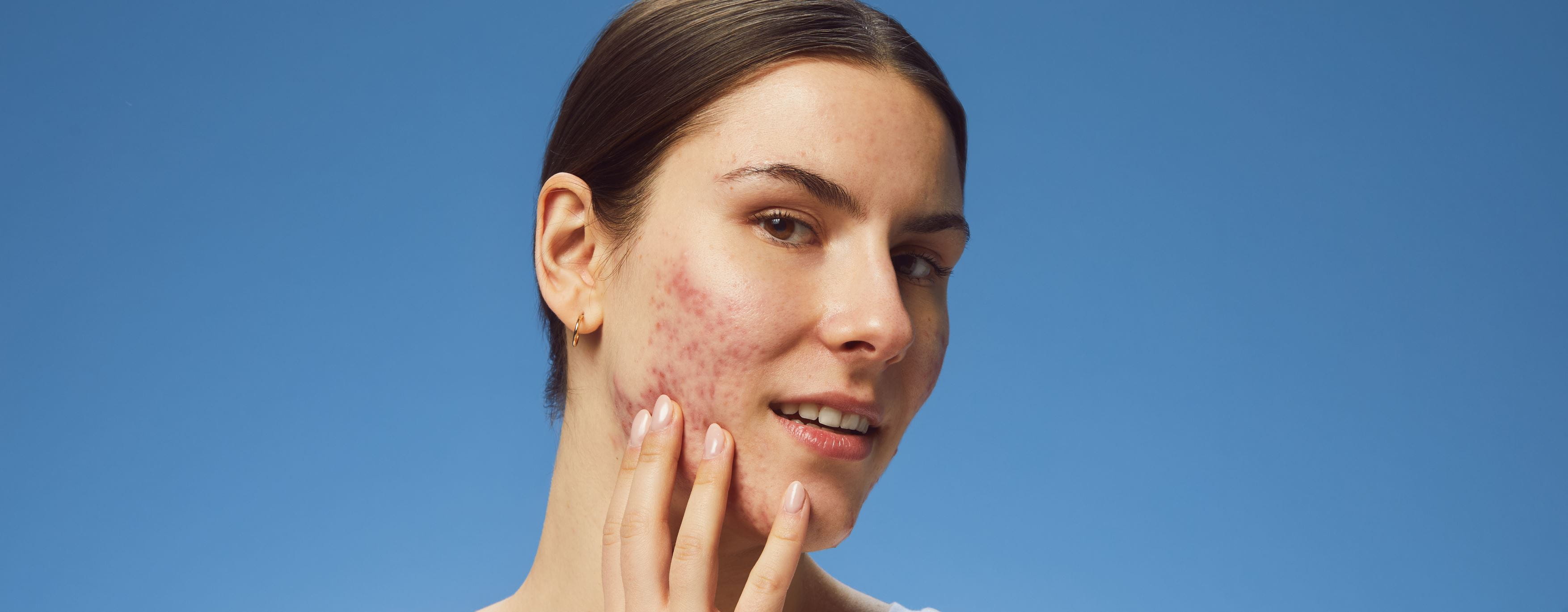 woman with breakouts