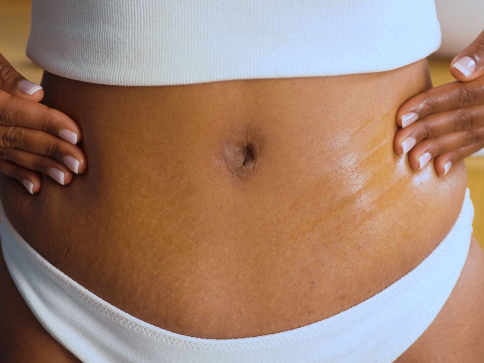 Mujer aplicando el suero de aceite corporal antiestrías NIVEA Luminous630