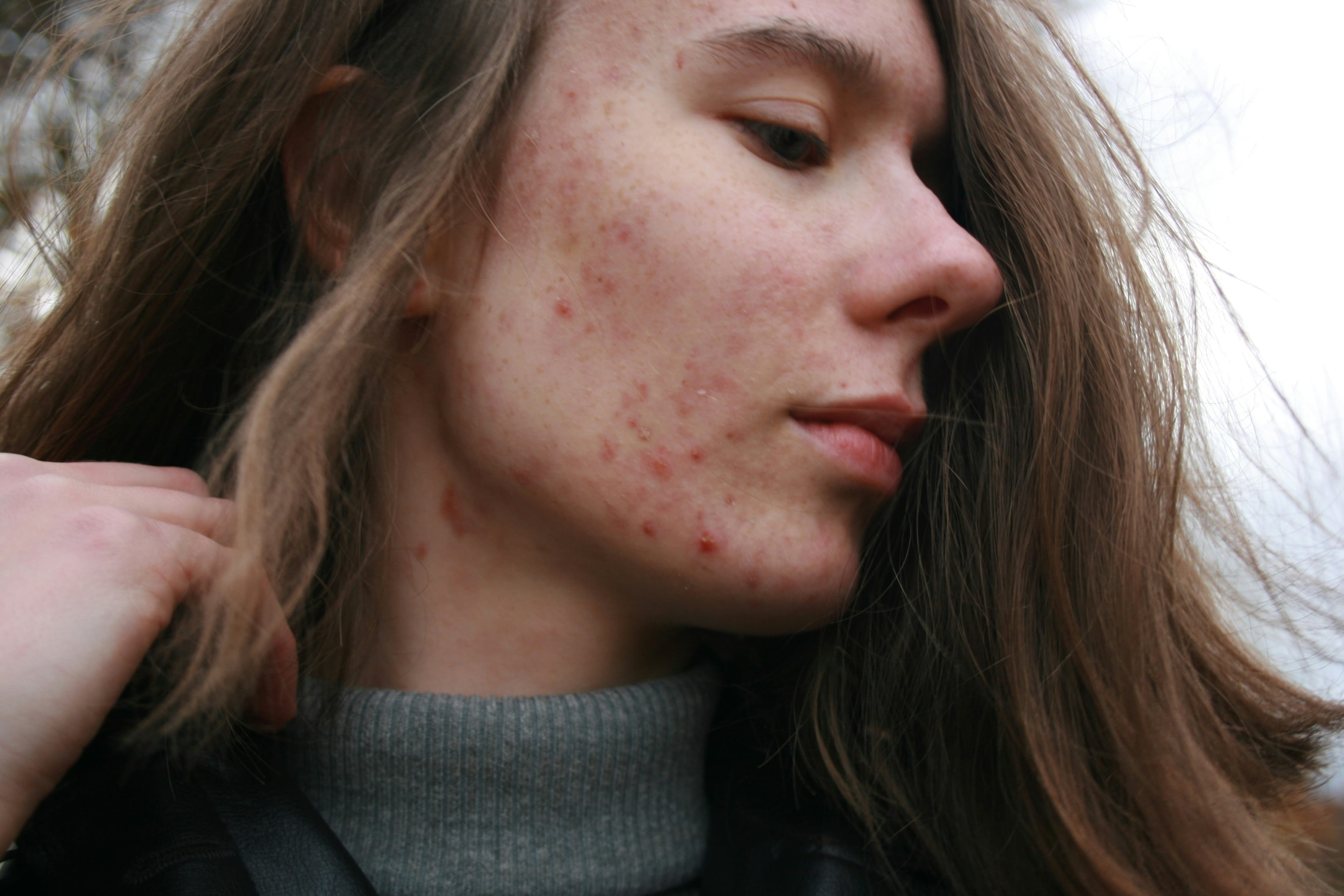 WHAT CAUSES ACNE?