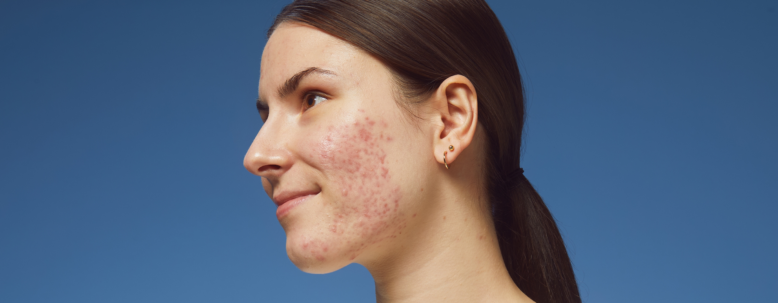 Skincare for Acne prone skin – Nivea India