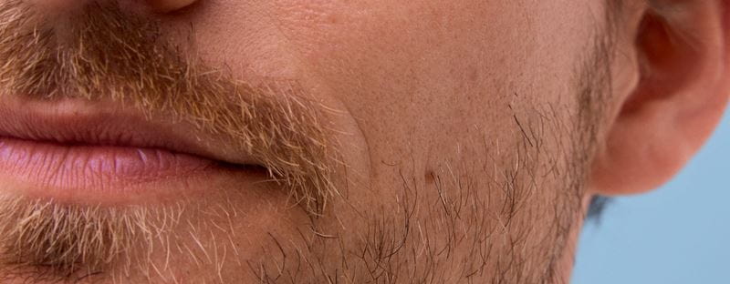 dermatite seborroica e forfora nella barba