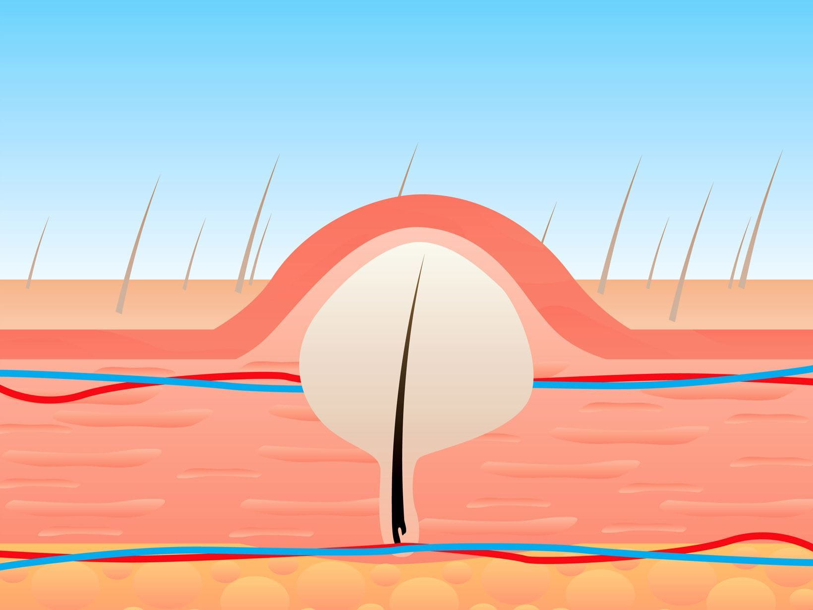 ingrown hair from shaving rash