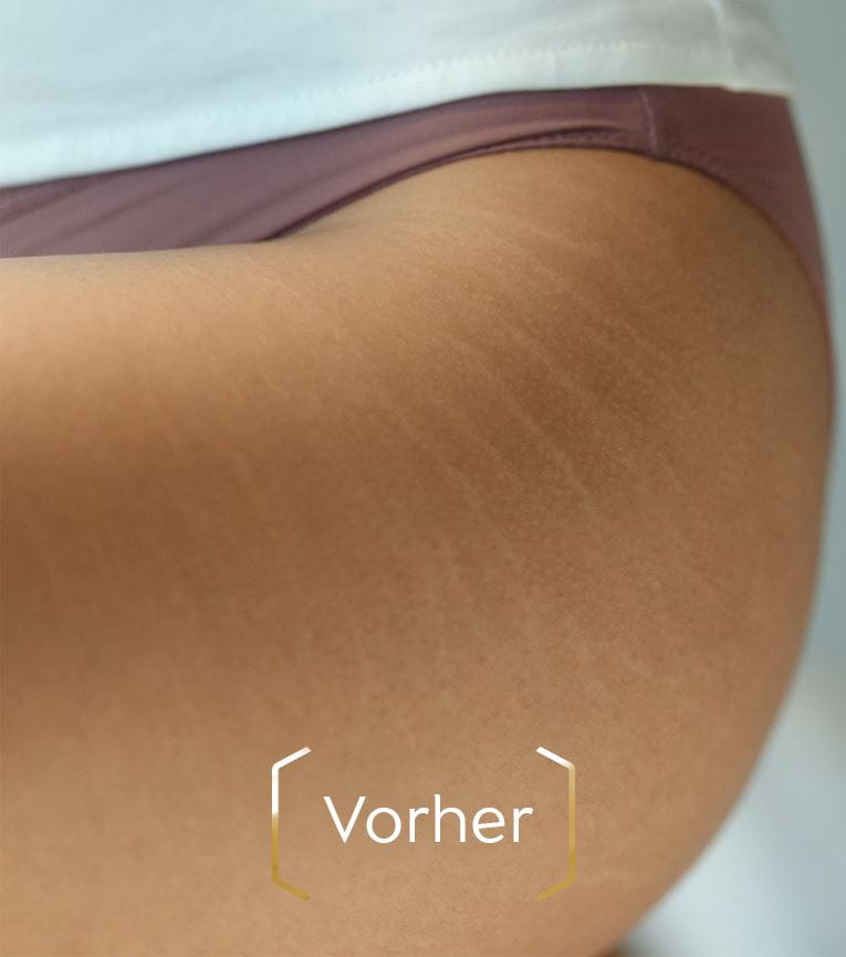 Zwei Bilder von Dehnungsstreifen, auf dem zweiten ist er sichtbar reduziert