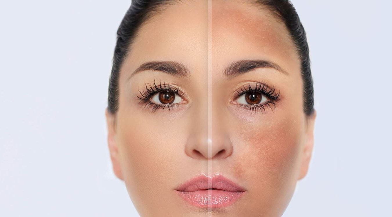 paño en el embarazo