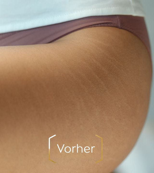 Vorher