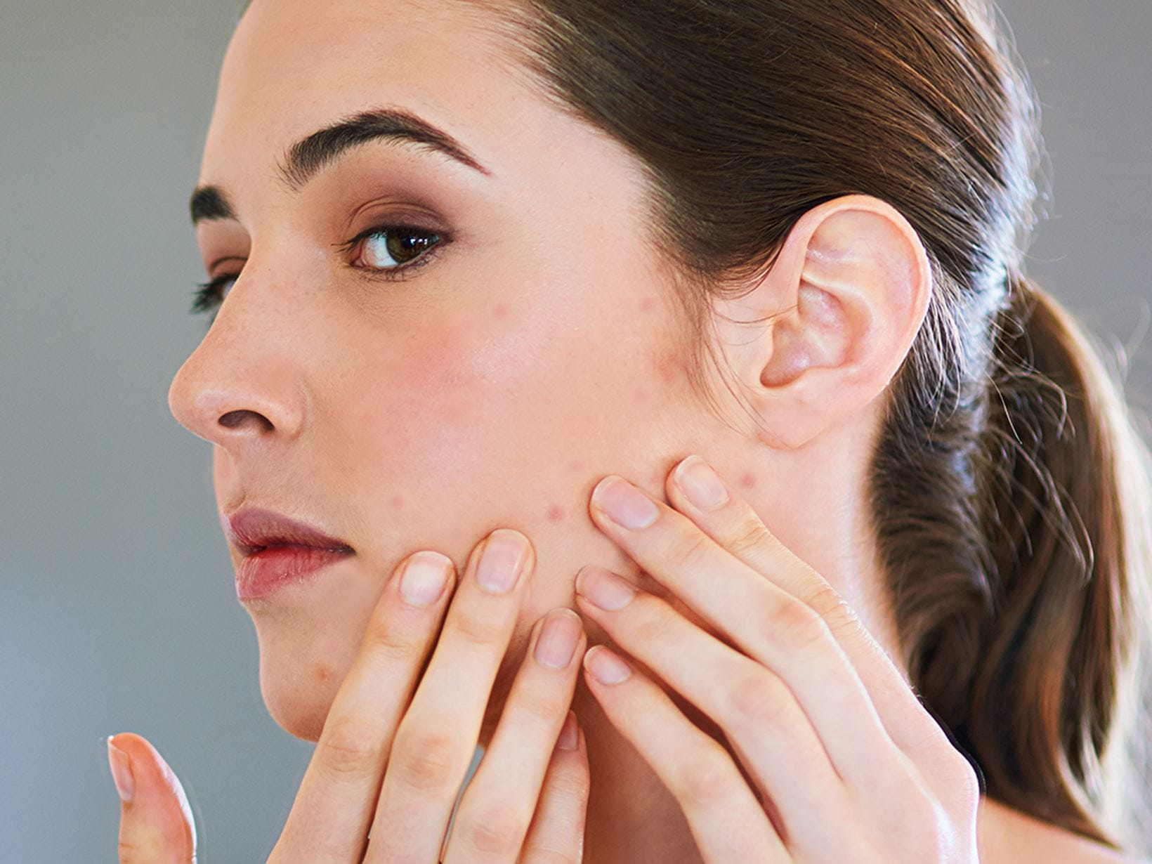 Pickelmale entfernen: Was hilft gegen die dunklen Flecken? - Thumbnail