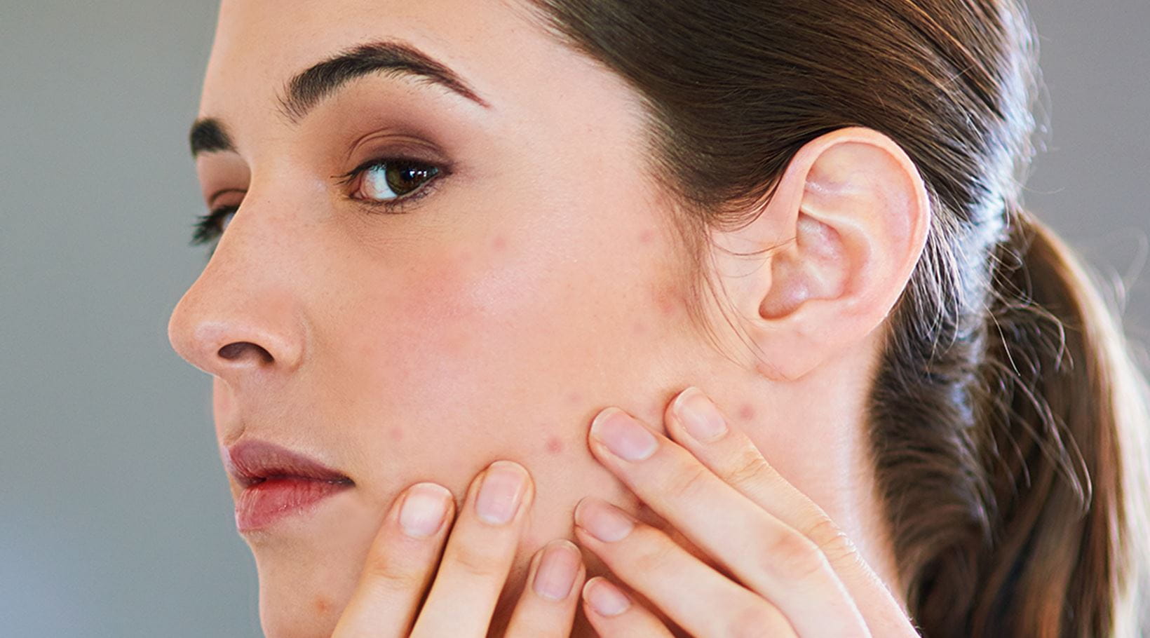 Pickelmale entfernen: Was hilft gegen die dunklen Flecken? - Thumbnail