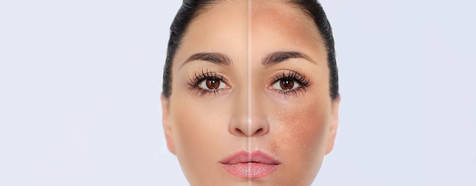 paño en el embarazo