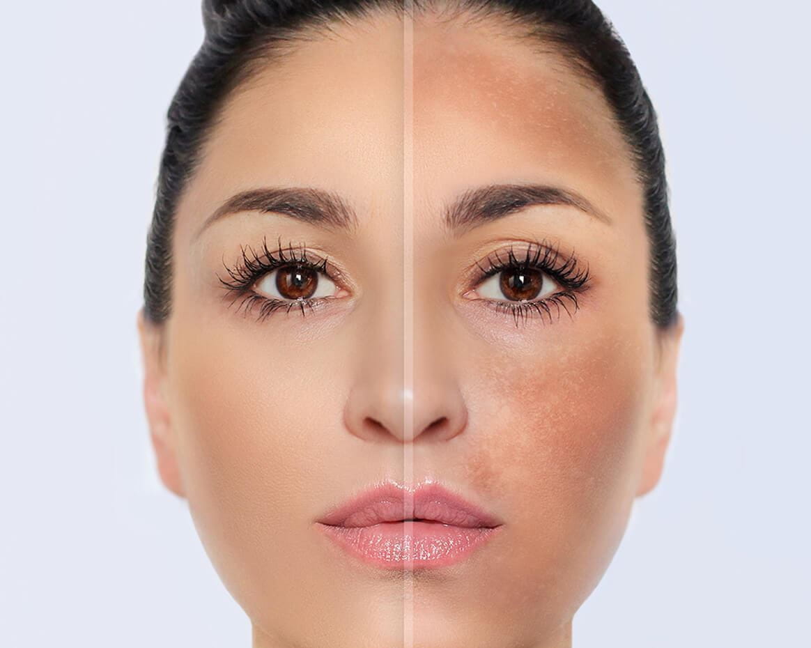 paño en el embarazo