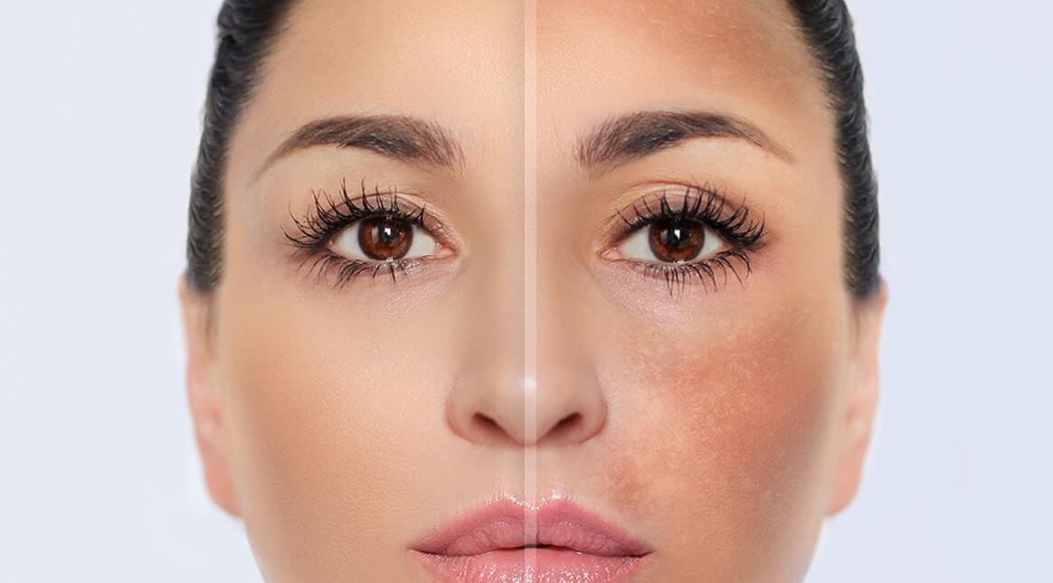 paño en el embarazo