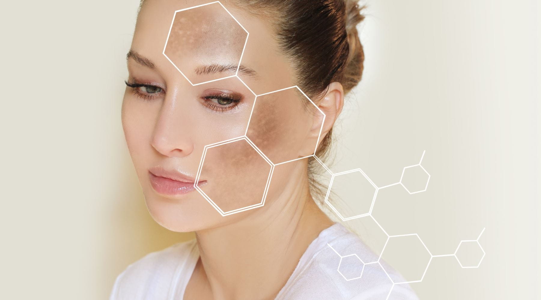 ¿Qué es melasma?
