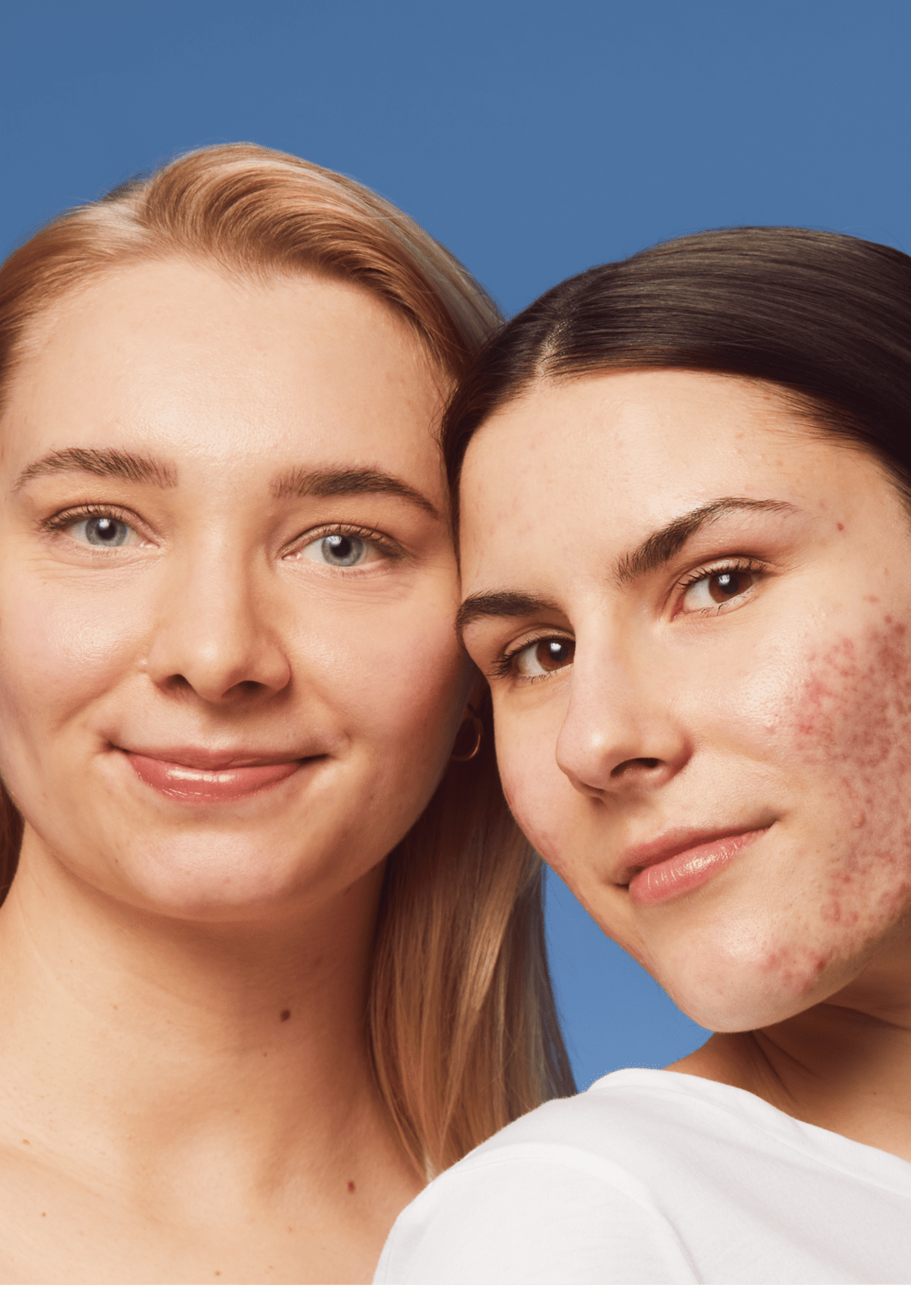 dziewczyny z trądzikiem