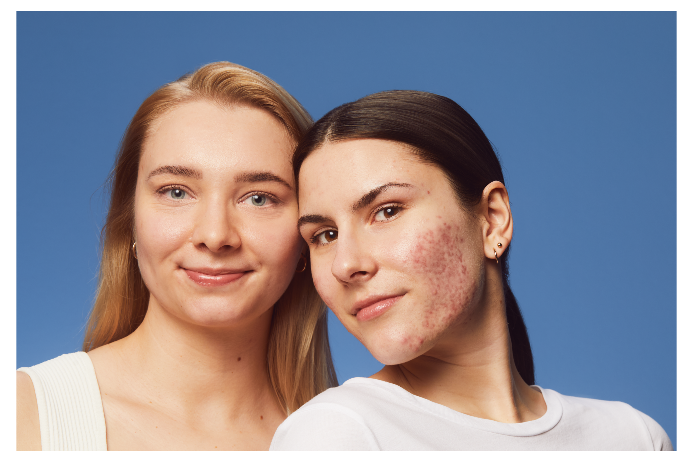 Breakouts Around Nose Area: Conquer Those Pesky Pores!
