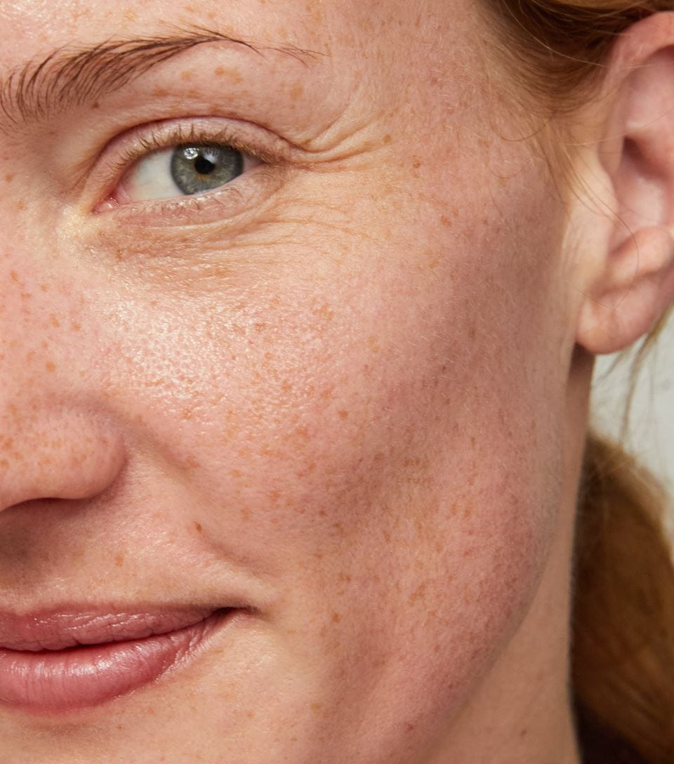femme qui a la peau pigmentée