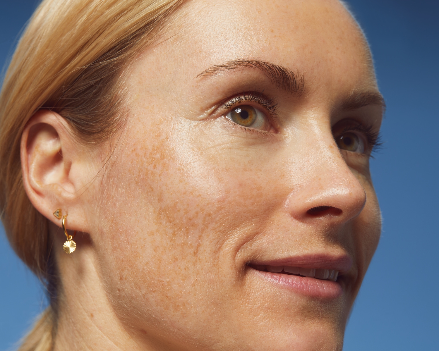 Women with dark spot on her face