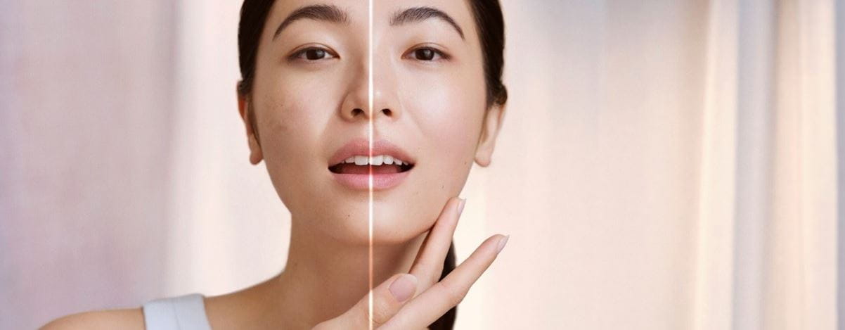 Woman's face before and after dark spot treatment