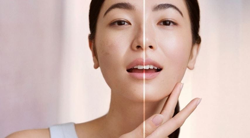 Woman's face before and after dark spot treatment