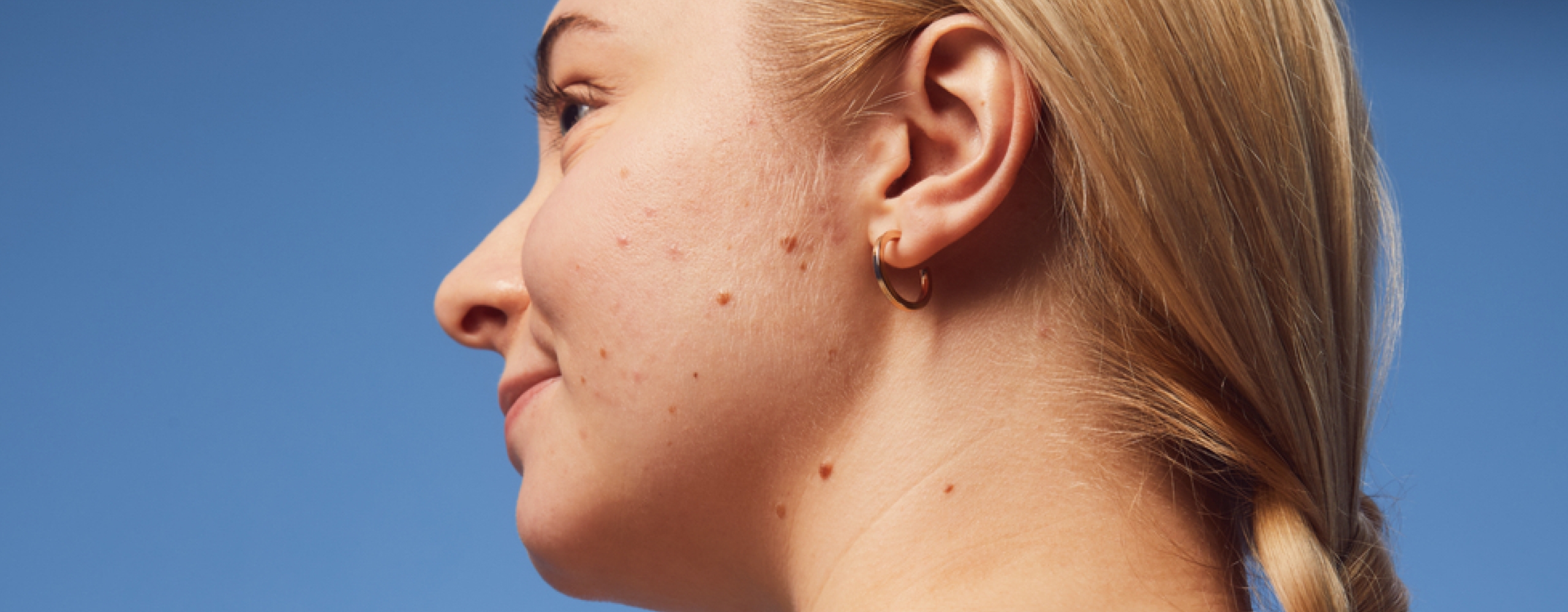 Mujer con brotes de granos internos