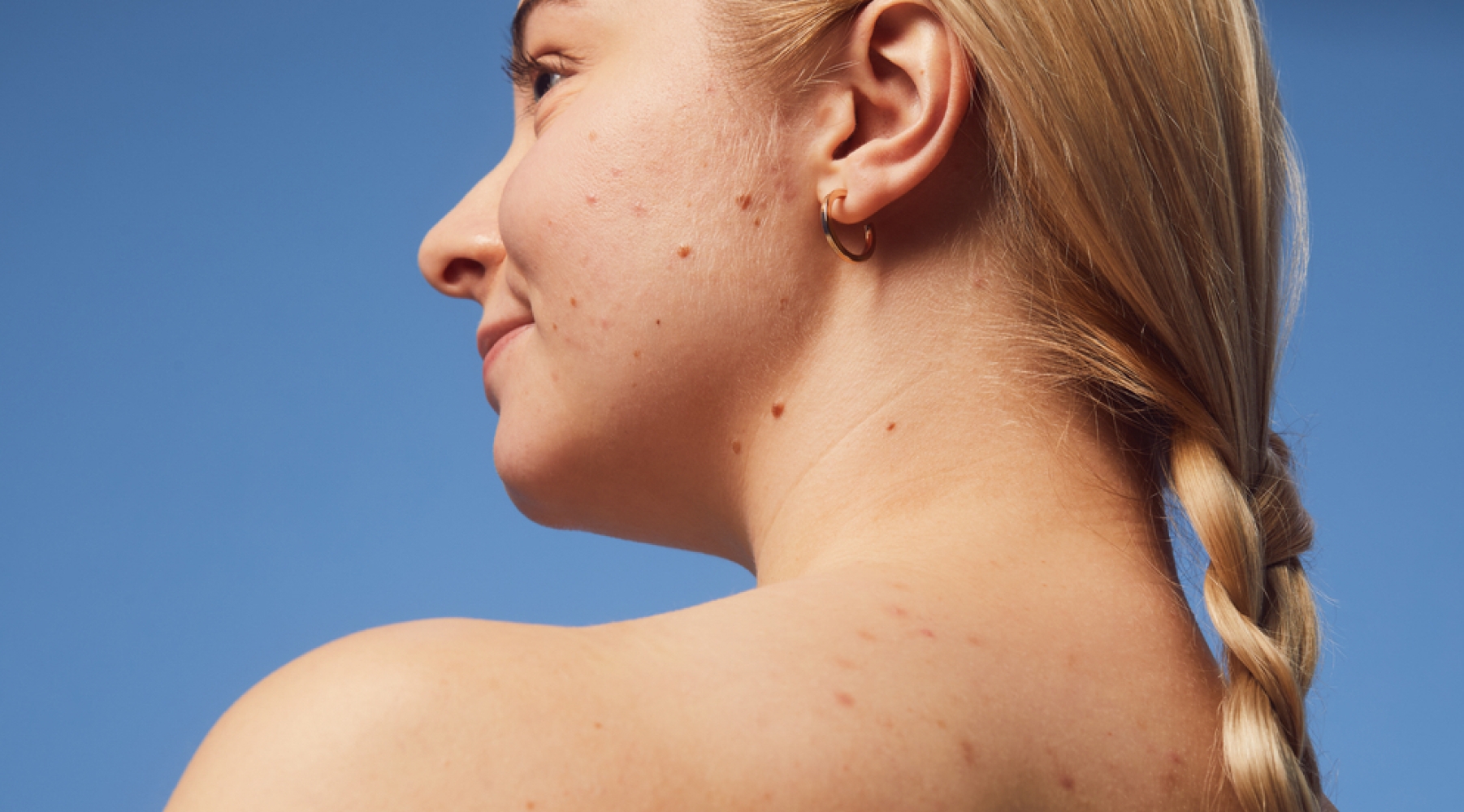 Mujer con brotes de granos internos