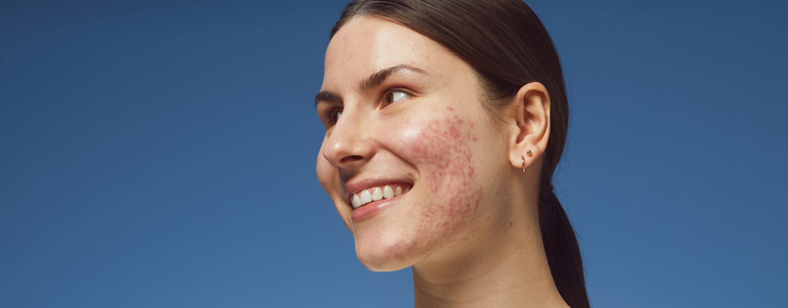  ¿Cómo se originan y cómo se eliminan las manchas de acné?