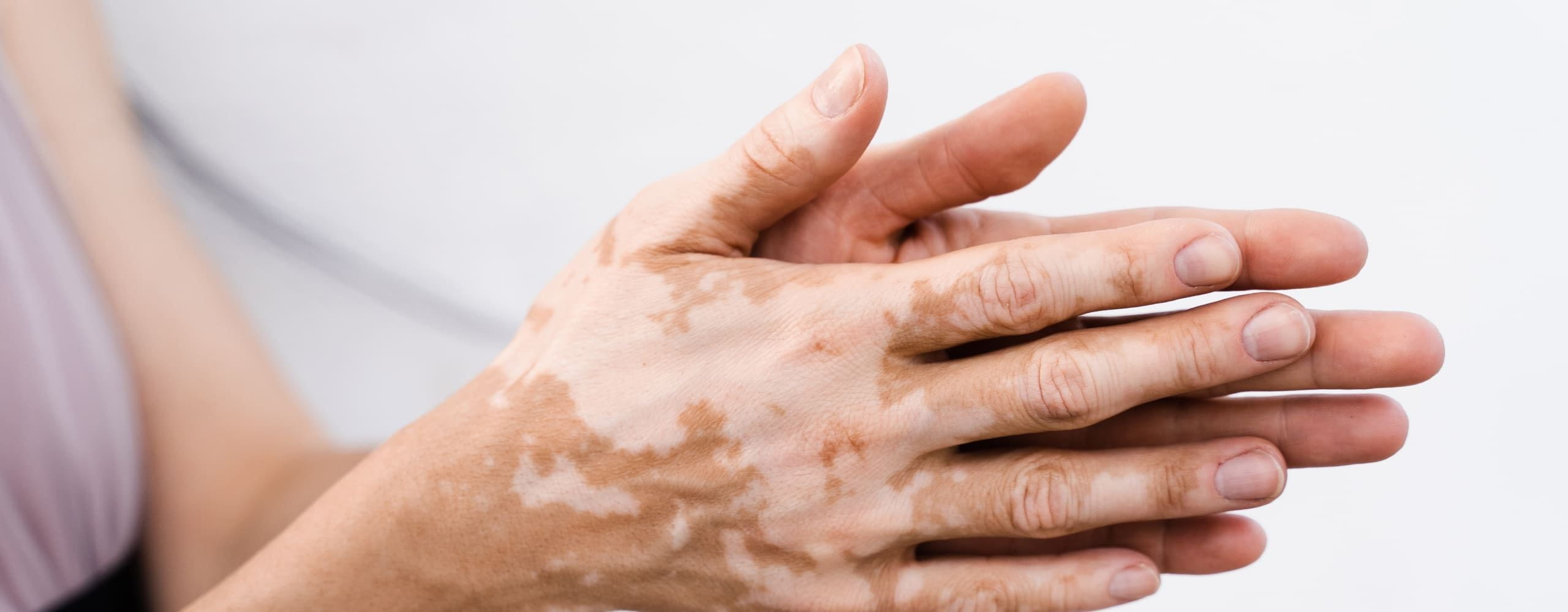 Vitiligo ¿Qué es?