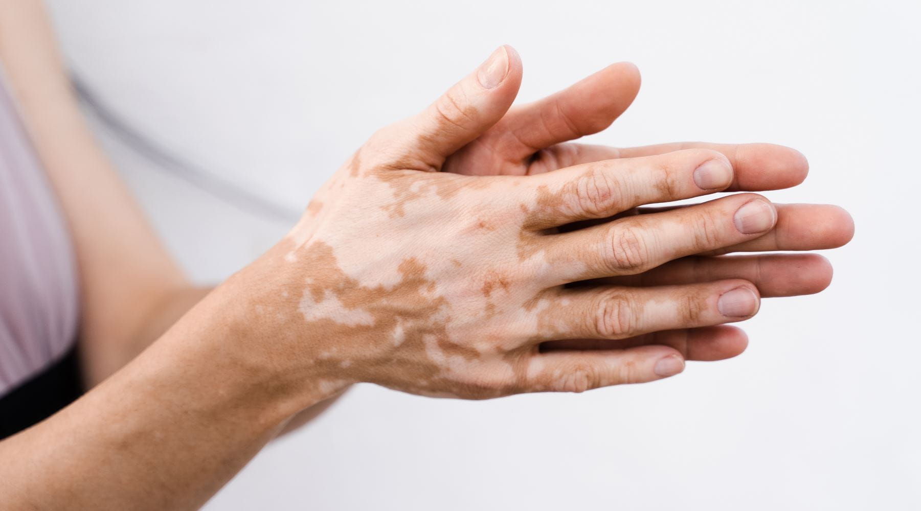 Vitiligo ¿Qué es?