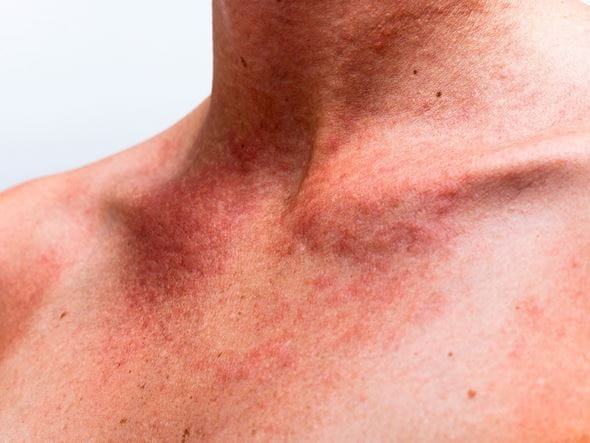 alergia na słońce