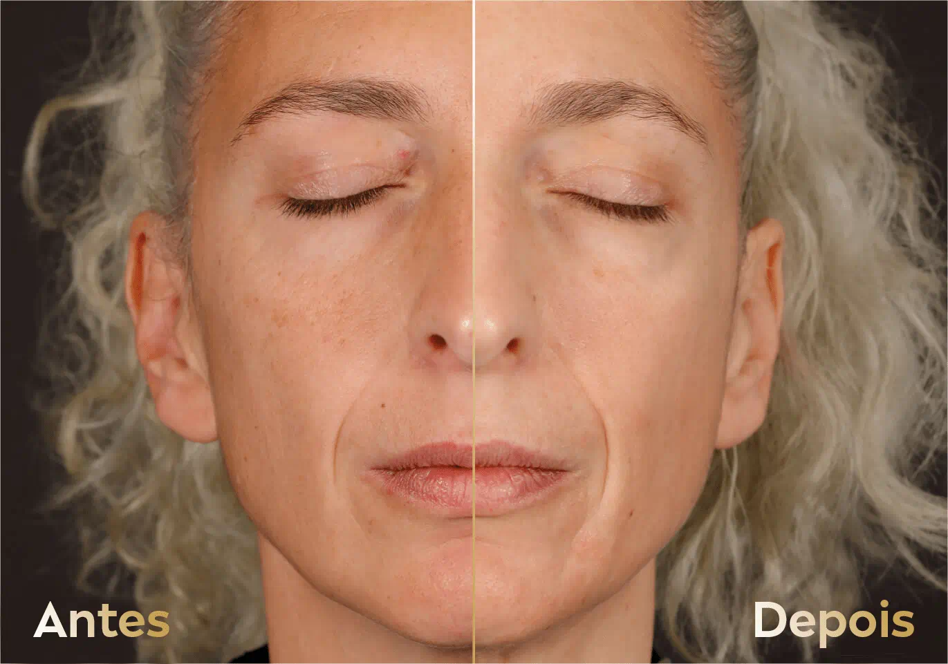 antes e depois