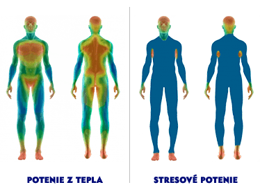 nadmerné potenie