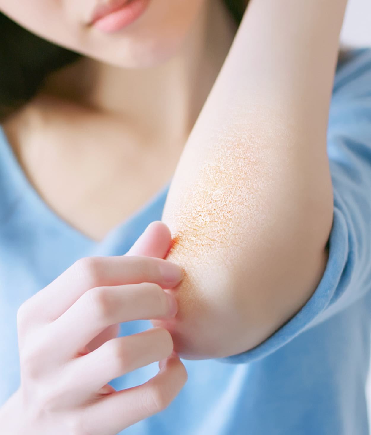 เคล็ดลับดูแลผิวแห้งคัน